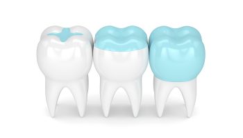 What Are The 4 Types Of Fillings?